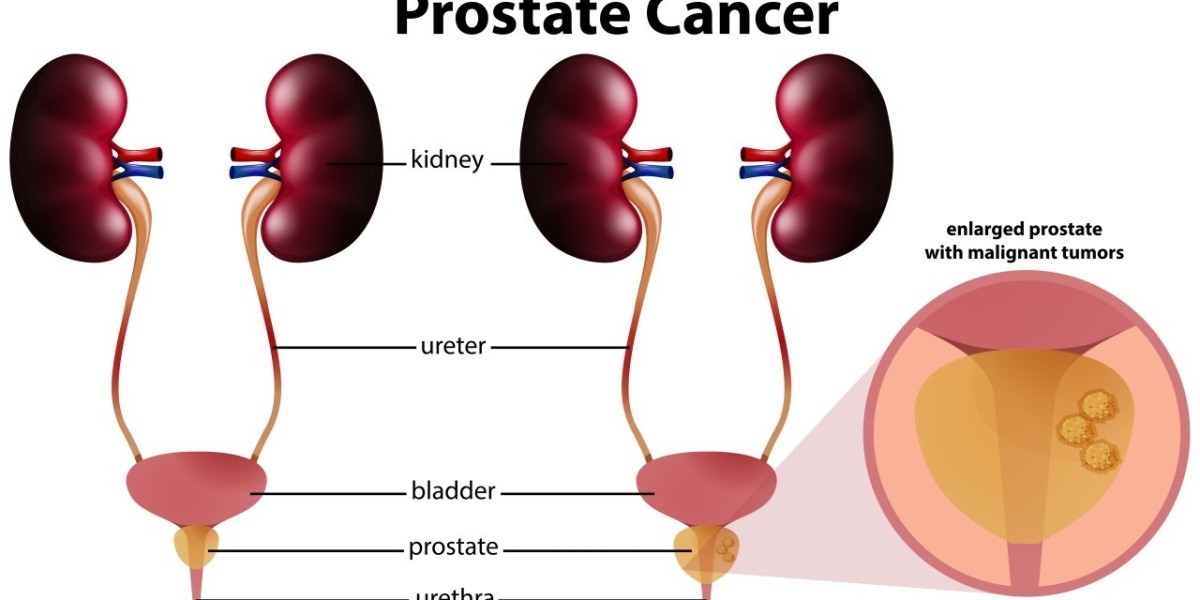 Prostate Cancer Treatment Market Report, Share, Trends and Global Forecast 2024-2032