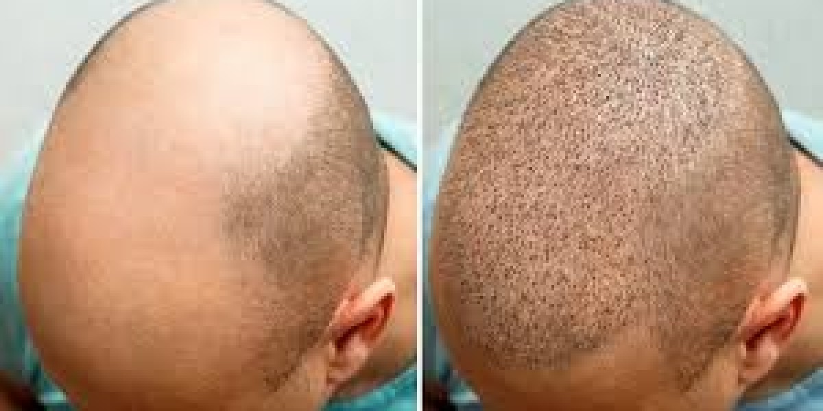 These are the top 10 hair transplant clinics in the Dubai