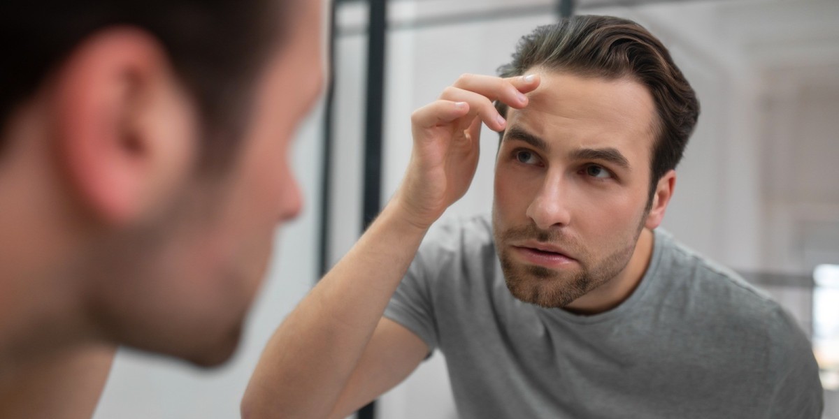 Hair Transplant in Delhi: Things You Must Know