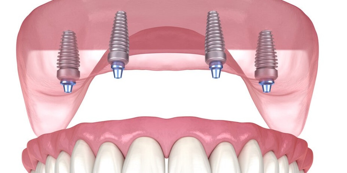 The Cost of Dental Implants: An Investment in Your Smile and Quality of Life