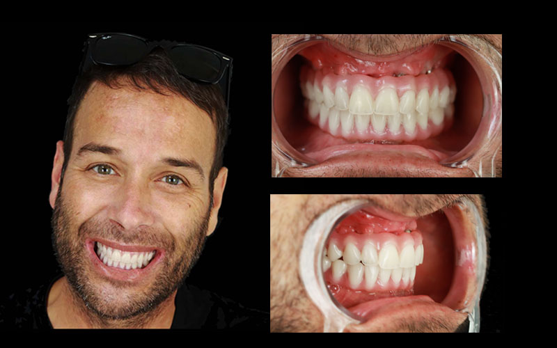 Tijuana Dentists Prices 2024. Veneers from $150