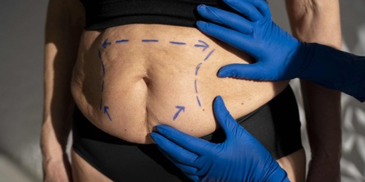 Transform Your Body with Tummy Tuck Surgery in Ludhiana