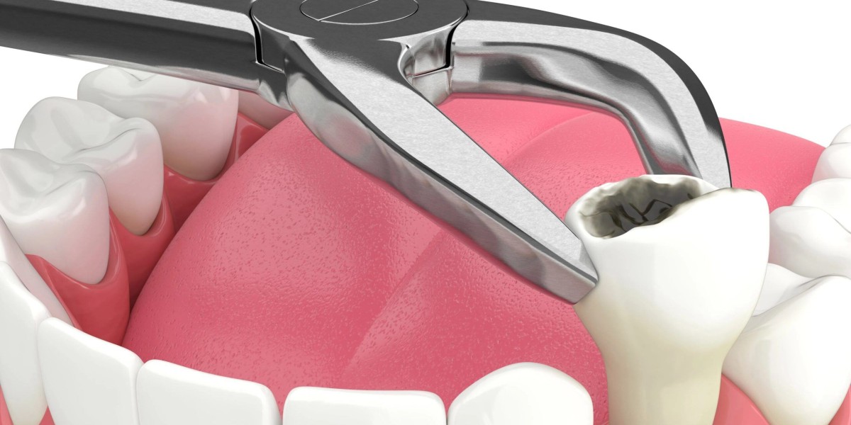 Swift and Professional Emergency Tooth Extraction in Santa Rosa at CA Dental Surgeons