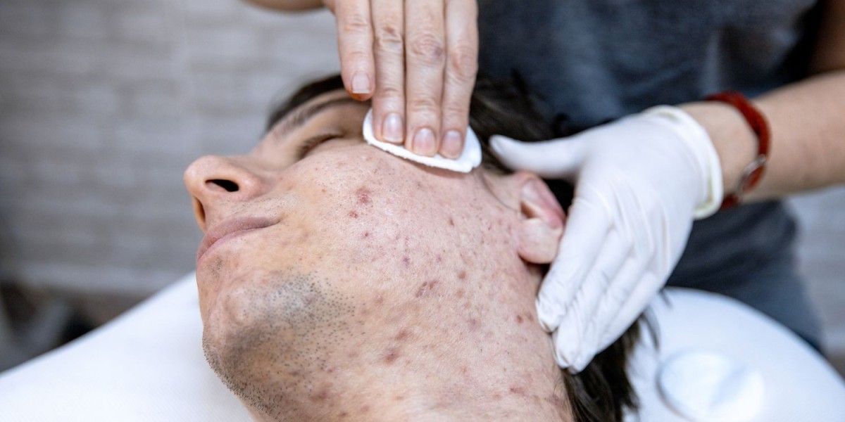 Acne Treatment Market Growth, Opportunities and Industry Forecast Report 2033