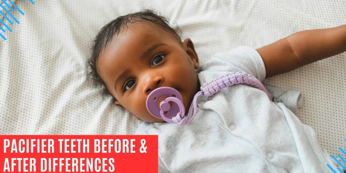 How Pacifiers Influence Dental Development: A Before and After Comparison