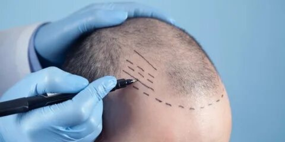 Hair Transplant in Dubai: A Detailed Breakdown of Costs and Options