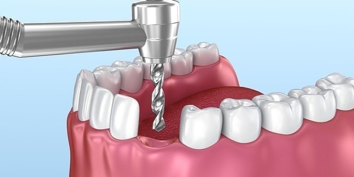 Dental Implants Market Set to Expand at 7.1% CAGR Amid Growing Elderly Population