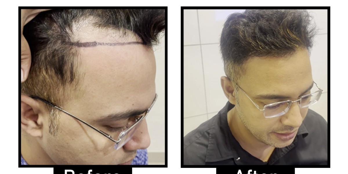 Best Hair Loss Treatments in Delhi: Solutions for Thinning Hair