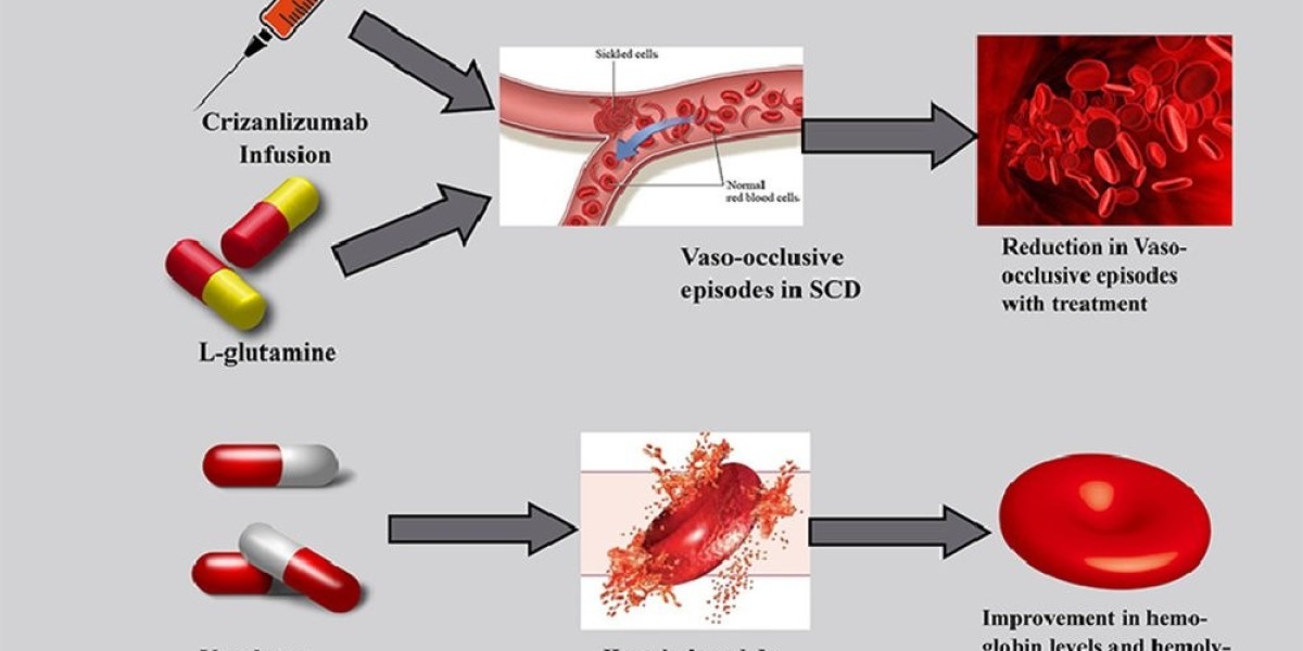 Sickle Cell Disease Treatment Market Size, Share, Challenges and Growth Analysis Report 2033