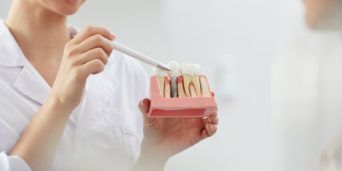 The Cost of the Best Dental Implants in Los Angeles: What to Expect