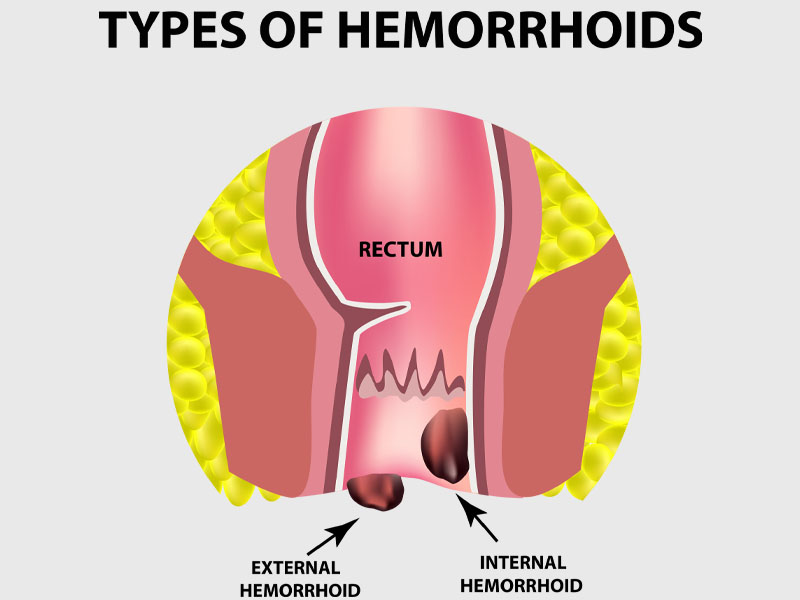 Ayurvedic Treatment for Piles| Haemorrhoids. Ayur Healthcare.