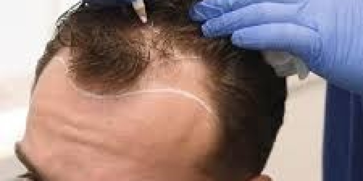 ما الذي يؤثر على تكلفة زراعة الشعر في دبي؟ العوامل الرئيسية! ?‍⚕️