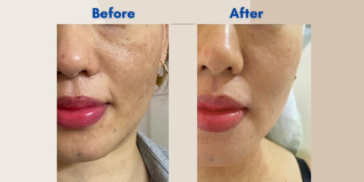 Best Chemical Peel Treatment in Bangalore