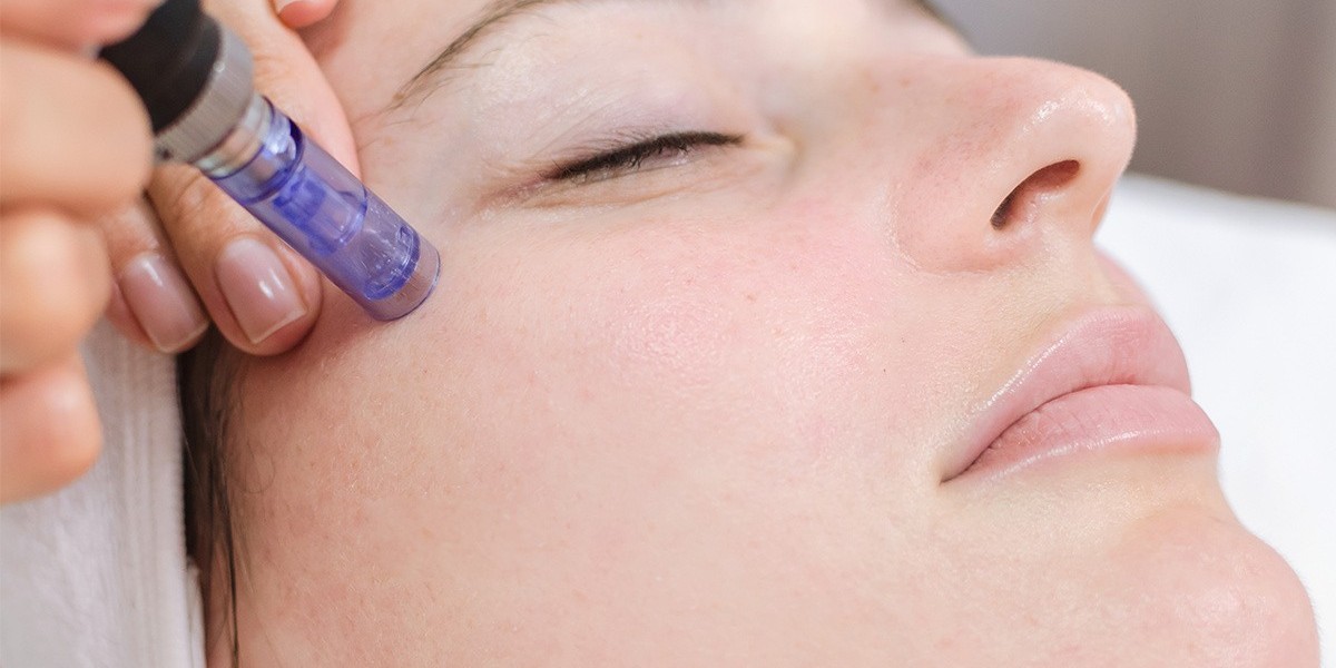 How Often Should You Get Microneedling Treatment in Islamabad?