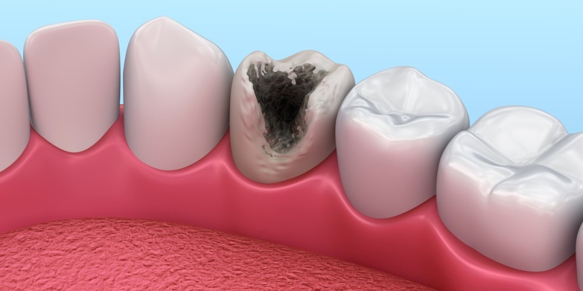 Dental Caries Treatment Market Driven by Increasing Incidence of Tooth Decay