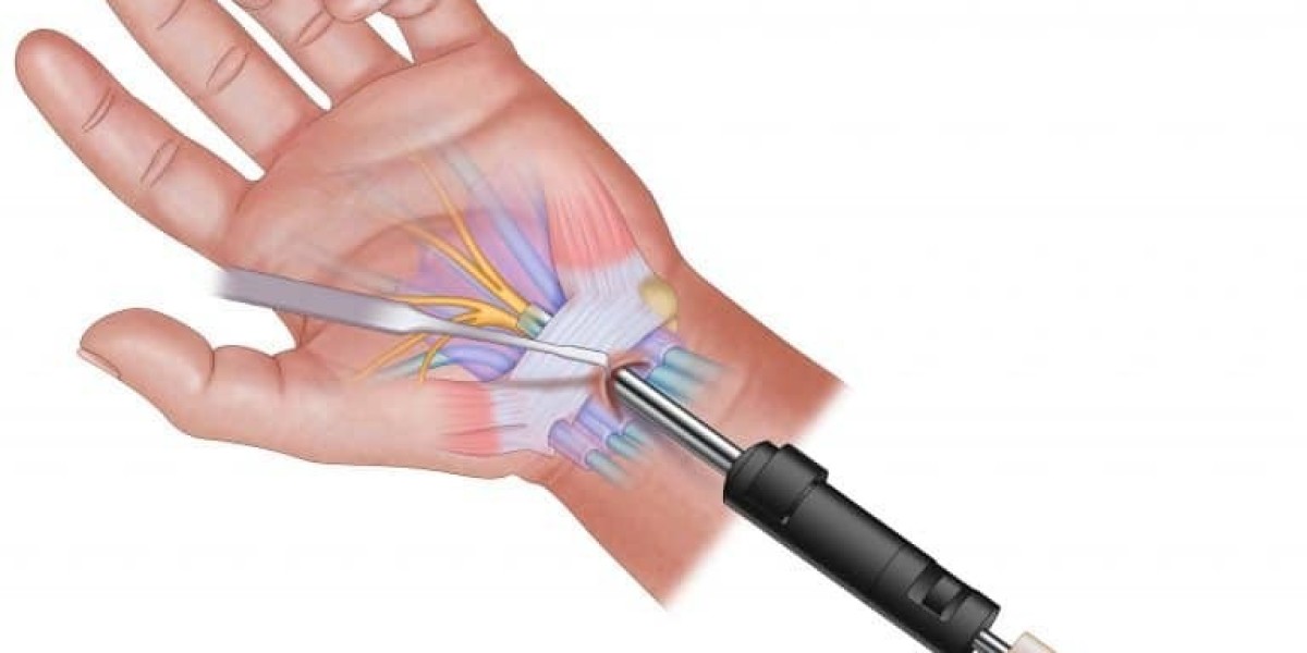 Understanding the Carpal Tunnel Release Systems Market: Key Factors Driving Growth