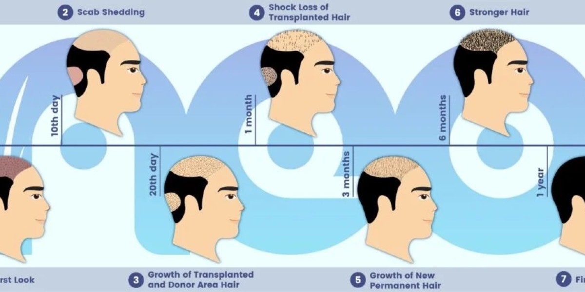 Why Hair Replacement Surgery in Turkey is Gaining Popularity