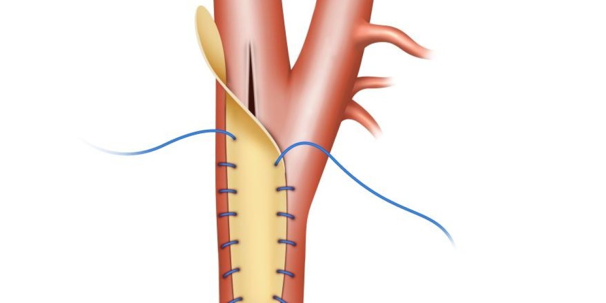 The Global Vascular Patches Market: Key Trends and Insights for 2024