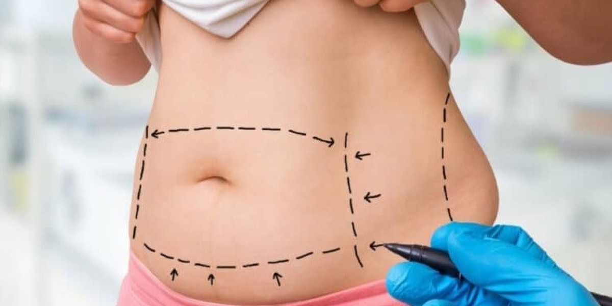 Tummy Tuck Cost in Islamabad: Financing Options and Payment Plans